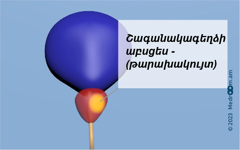 Շագանակագեղձի աբսցես - շագանակագեղձի թարախակույտ