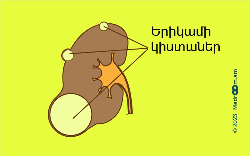 Երիկամի կիստա
