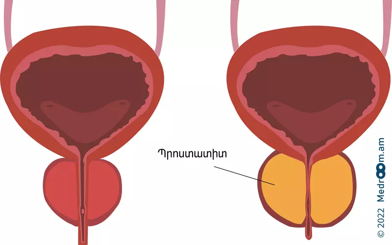 պրոստատիտ