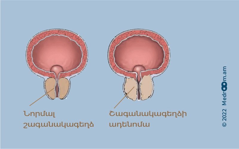 Շագանակագեղձի ադենոմա