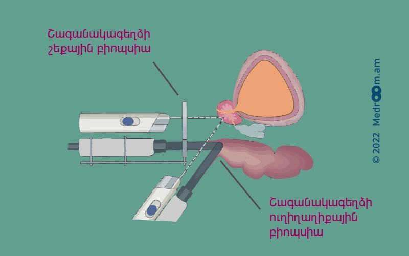 Շագանակագեղձի բիոպսիա