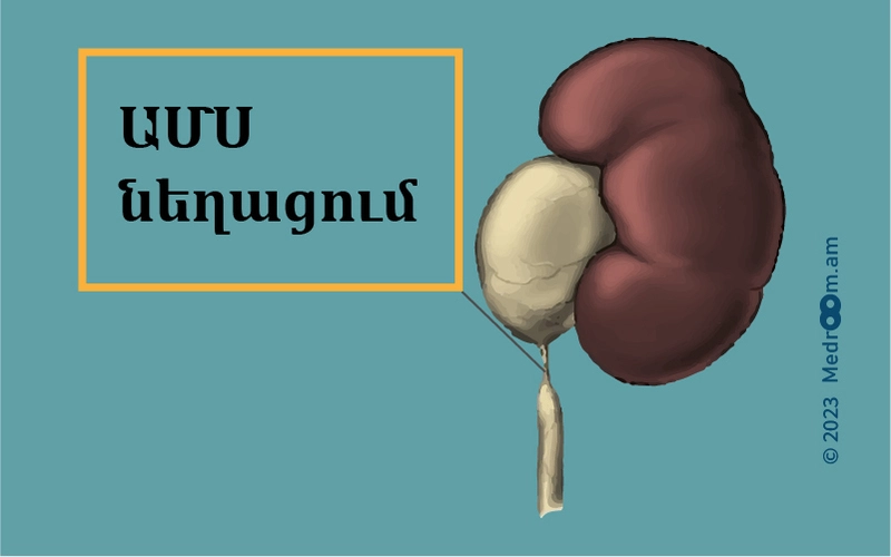 Ավազան – միզածորանային սեգմենտի նեղացում