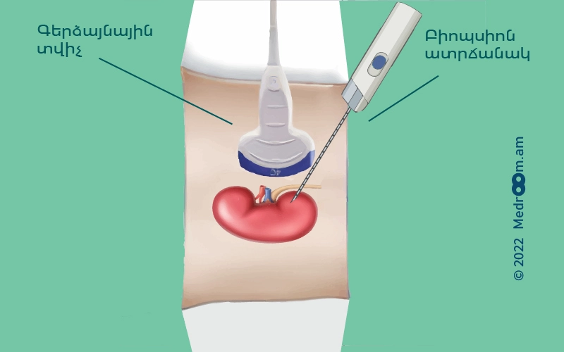 Երիկամի բիոպսիա