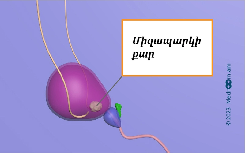 Միզապարկի քար