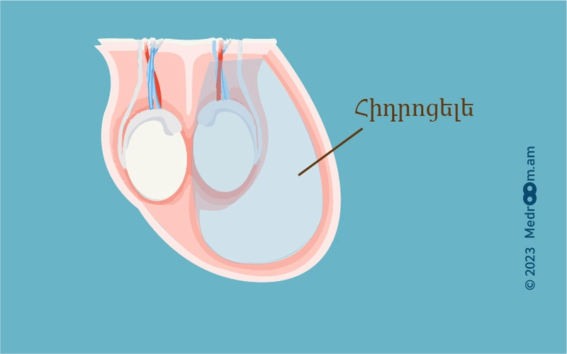 Հիդրոցելե, ամորձիների ջրգողություն