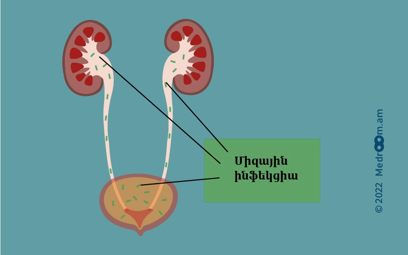 Միզուղիների ինֆեկցիա